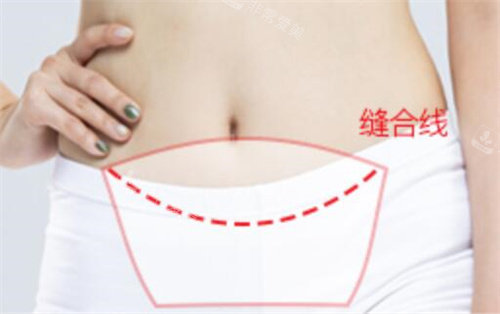韩国欧佩拉腹部整形术缝合线示意图