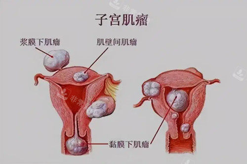 子宫肌瘤常见类型