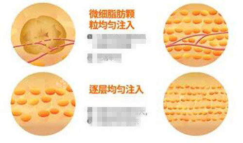 韓國秀美顏整形外科脂肪填充優(yōu)勢分析