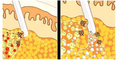 韓國(guó)貝緹萊茵整形醫(yī)院吸脂手術(shù)示意圖 韓國(guó)貝緹萊茵整形醫(yī)院吸脂手術(shù)示意圖
