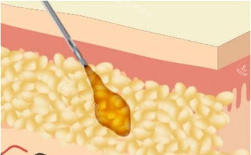 韩国贝缇莱茵整形医院手术方法