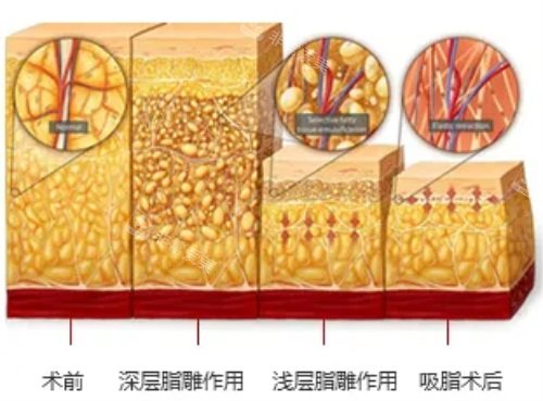 吸脂前后脂肪对比图