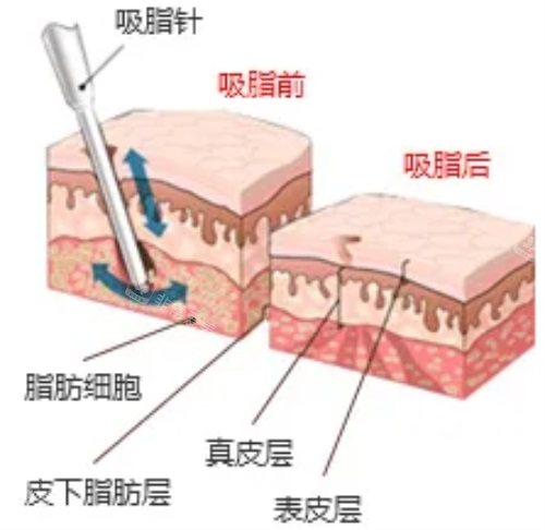 抽脂前后脂肪细胞差别图