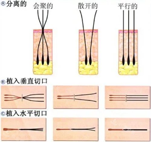 毛囊单位模式图 毛囊单位模式图