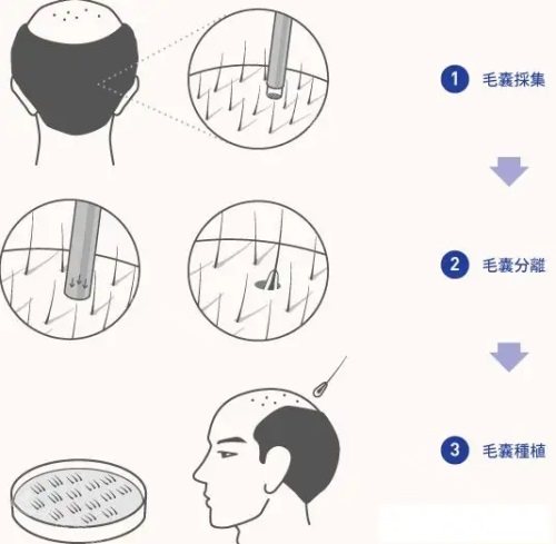 植发毛囊移植过程图 植发毛囊移植过程图