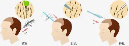 毛发移植过程示意图 毛发移植过程示意图