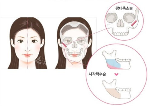 韩国cookie磨骨手术卡通图