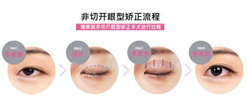 韩国德莱茵整形“非切开眼型矫正”流程图