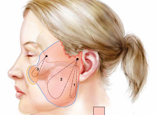 面部衰老提升区域图示