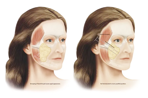 埋線提升手術(shù)示意圖