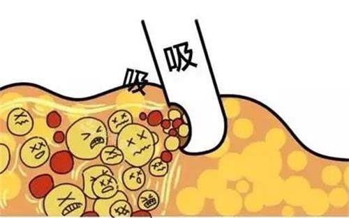 自體脂肪豐胸吸脂過(guò)程圖