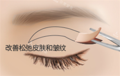 上眼皮松弛下垂解決方法示意圖 上眼皮松弛下垂解決方法示意圖