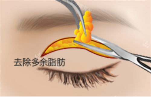 眼皮松弛怎么改善 眼皮松弛怎么改善