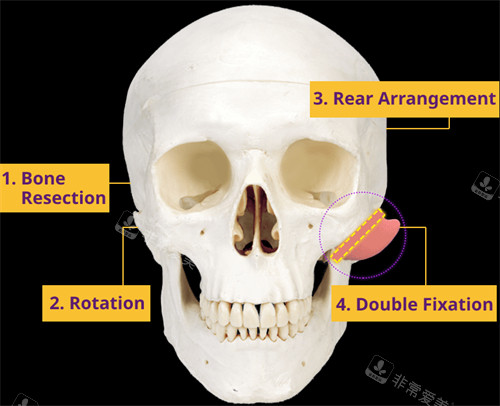 EU颌面整形外科的金钟润和申熙震都是韩国专门做轮廓的医生