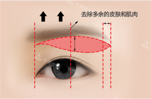 上眼皮松弛下垂手術(shù)方式示意圖