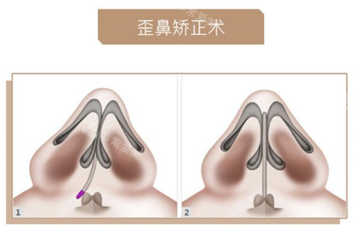 歪鼻矯正前后對比圖