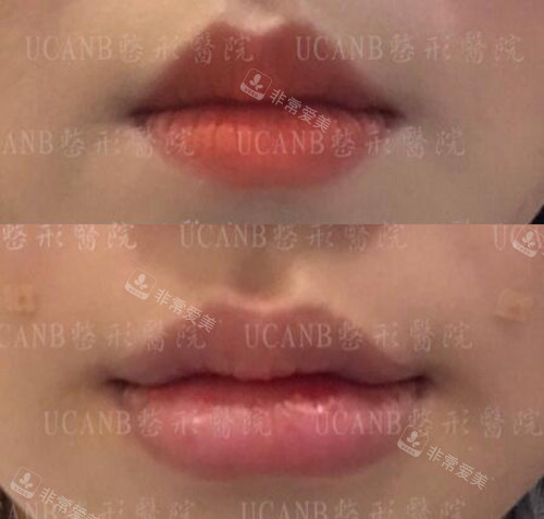 韩国UcanB整形丰唇改善不错，对比图分享真实结果！