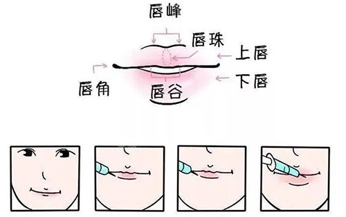 唇部整形卡通示意图