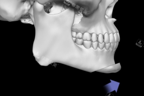 韩国H整形外科医院下巴前推