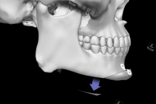 韩国H整形外科医院下巴手术展示图