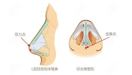 假体隆鼻和鼻综合整形