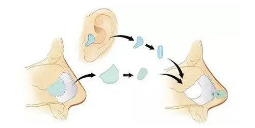 耳软骨隆鼻示意图