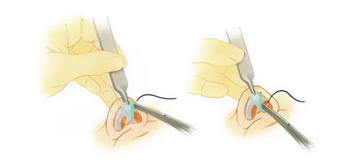 隆鼻手术示意图