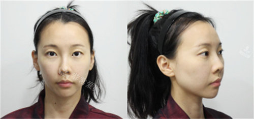 雙眼皮修復術前照片 雙眼皮修復術前照片