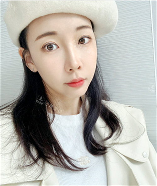 韓國樂日整形眼部修復后照片 韓國樂日整形眼部修復后照片