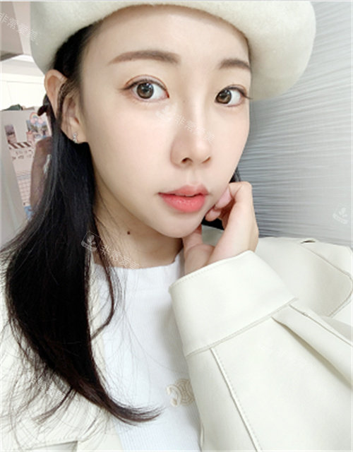 韓國樂日整形埋線雙眼皮修復后照片 韓國樂日整形埋線雙眼皮修復后照片