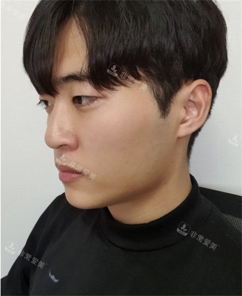 男士隆鼻術(shù)前照片 男士隆鼻術(shù)前照片