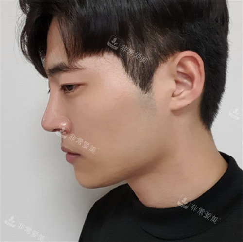 韩国乐日整形男士隆鼻术后图片