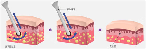 吸脂步驟圖 吸脂步驟圖