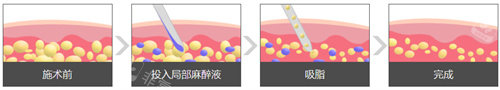 吸脂手術(shù)過程圖