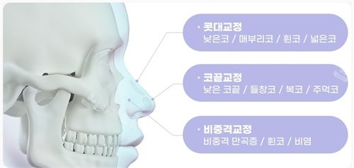 韩国绮林整形医院无假体鼻整形特色