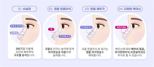 韩国绮林整形医院无假体鼻整形手术过程