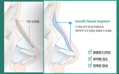 韓國(guó)綺林3D打印鼻子整形對(duì)比普通假體隆鼻