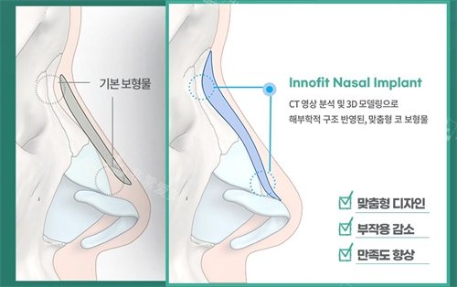 韓國綺林3D打印鼻子整形對比普通假體隆鼻