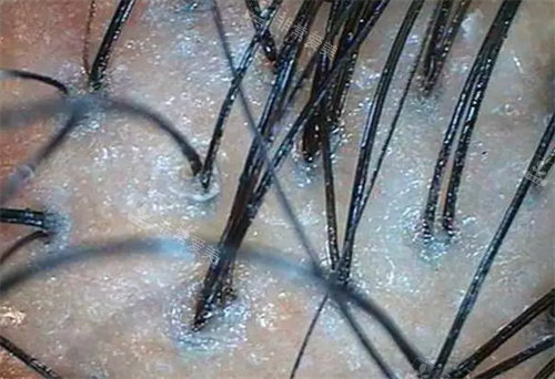 健康毛囊照片 健康毛囊照片