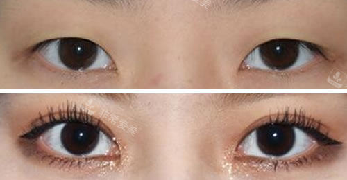 韩国秀美颜整形外科双眼皮对比图