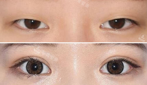 韩国秀美颜整形外科眼综合整形对比