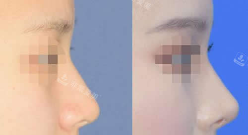韩国秀美颜整形外科隆鼻对比图