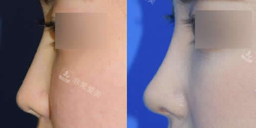 韩国秀美颜整形外科隆鼻特点展示