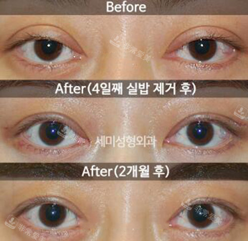 韩国世美整形外科眼修复改善