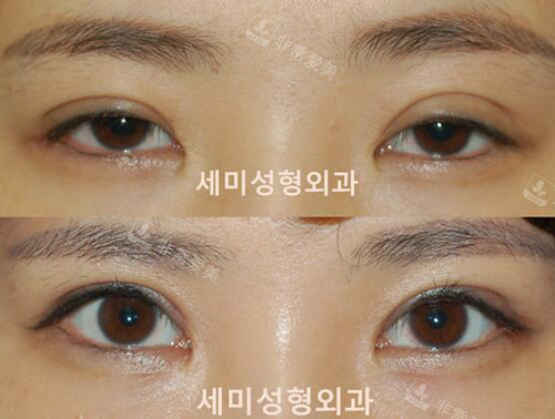 韩国世美整形眼修复改善对比