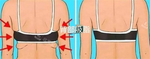 背部吸脂前后對(duì)比圖 背部吸脂前后對(duì)比圖