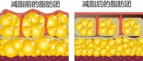 吸脂前后脂肪團(tuán)對(duì)比圖 吸脂前后脂肪團(tuán)對(duì)比圖