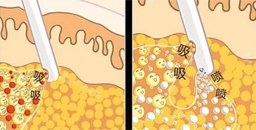 傳統(tǒng)吸脂與水動(dòng)力吸脂對(duì)比圖 傳統(tǒng)吸脂與水動(dòng)力吸脂對(duì)比圖