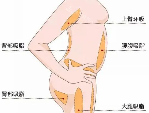 身體吸脂部位示意圖 身體吸脂部位示意圖