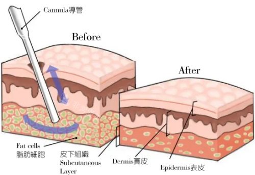 抽脂前后脂肪对比图